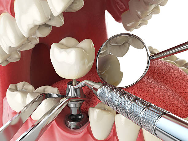 Best Emergency Root Canal Treatment in Greenock, PA